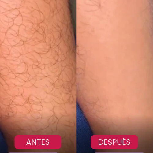 ¡Por fin, una Piel perfecta sin Sufrimiento!