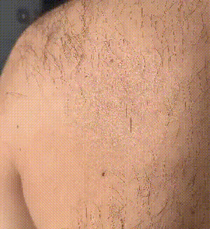 ¡Por fin, una Piel perfecta sin Sufrimiento!