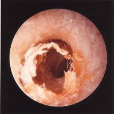 Cámara de Eliminación de Cera de Oído